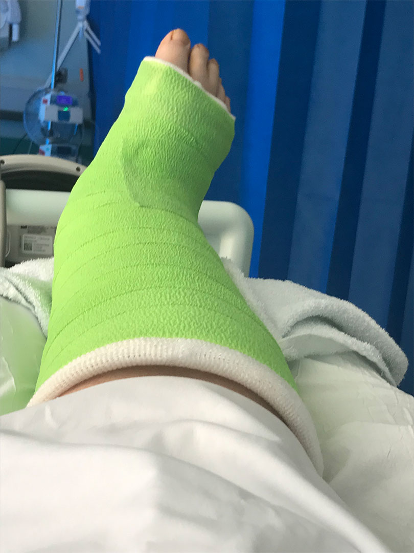 A leg in a green covered plaster cast